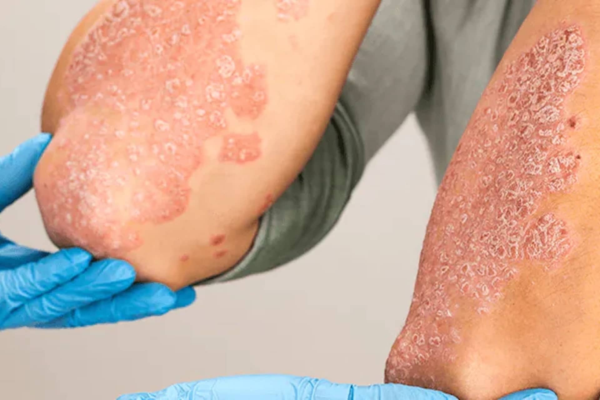 Understanding Plaque Psoriasis: Symptoms, Diagnosis, and Treatment Options